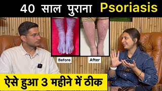 Psoriasis Treatment In Hindi Ft upasanakiduniya  Skin Disease  Himanshu Bhatt [upl. by Drais]