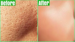 How To Get Rid Of LARGE PORES PERMANENTLY 100 Works Shrink amp Get Clear Glass Skin Naturally [upl. by Luebke13]