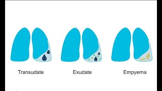 How to recognize different pleural effusions on chest CT [upl. by Ahsyle331]