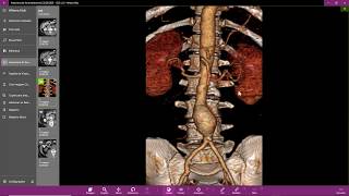 Aneurismas de Aorta Dr Alexandre Amato [upl. by Lara]