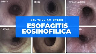 Esofagitis Eosinófilica Cómo diagnósticarlo y tratarlo en el 2021 [upl. by Acker]