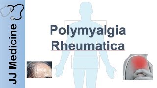 Polymyalgia Rheumatica  Signs amp Symptoms Diagnosis and Treatment [upl. by Bernadina903]