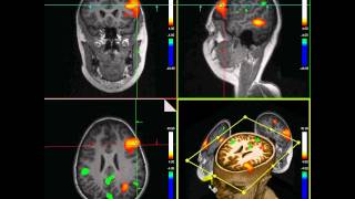 fMRI Functional MRI [upl. by Inat384]