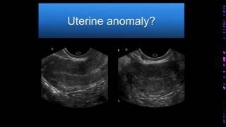 What causes Endometrial thickness  DrSmitha Sha of Cloudnine Hospitals  Doctors Circle [upl. by Merline]