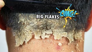 Psoriasis Scalp Scratching Big Flakes 610 [upl. by Amata]