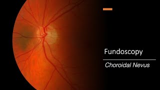 Choroidal Nevus Fundoscopy [upl. by Tremain]