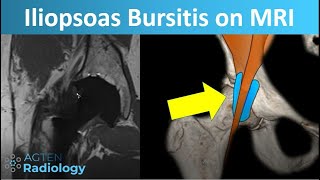 MRI of the Iliopsoas Bursitis and Its Pitfalls [upl. by Nwadrebma]