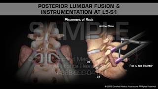 Posterior Lumbar Fusion amp Instrumentation at L5S1 [upl. by Suivat]