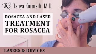 Rosacea and laser treatment for rosacea [upl. by Imelida]