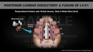 Posterior Lumbar Discectomy amp Fusion of L4S1 [upl. by Nerred]