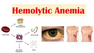 Hemolytic Anemia [upl. by Eanal]