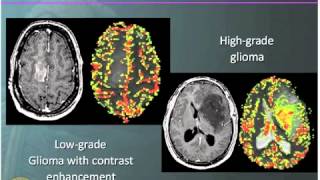 Doctor Explains Glioma Brain Tumor [upl. by Elleunamme216]