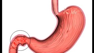 DUODENITIS INFLAMACIÓN DEL DUODENO [upl. by Lean]