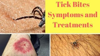 Tick Bites Symptoms and Treatments [upl. by Vinna]