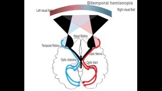 Bitemporal hemianopia [upl. by Janna]