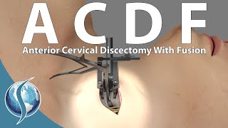 Anterior Cervical Discectomy and Fusion [upl. by Diandra121]