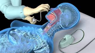 Endotracheal Intubation MICU Fellows Airway Course [upl. by Aicnatsnoc]