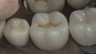 Class I Composite Preparation amp Restoration  Operative Dentistry [upl. by Joannes]