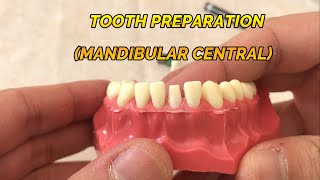 CROWN PREPARATION TUTORIAL MANDIBULAR CENTRAL [upl. by Downing]