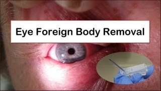 Eye Foreign Body Removal [upl. by Yauqaj]