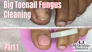 How To Pedicure Toenail Fungus Home Remedy Cleaning Part 1 [upl. by Naves]