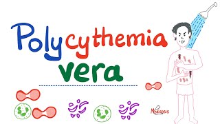 Polycythemia Vera PV  Myeloproliferative Neoplasm MPN  Erythrocytosis  Hematology [upl. by Mauve]