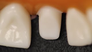 All Ceramic Crown Anterior Tooth Preparation [upl. by Jankell]