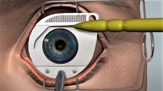 How LASIK Eye Surgery Is Performed [upl. by Leroy223]