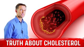 The Truth About Cholesterol – LDL Cholesterol amp HDL Cholesterol – DrBerg [upl. by Pearla]