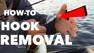 How To Fishing Hook Removal  ANGLER BURIES HOOK IN HAND [upl. by Cassilda]