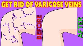 How to get rid of Varicose Veins naturally in 3 minutes a day [upl. by Fidellas179]