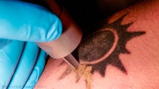 How Laser Tattoo Removal Works  Smarter Every Day 123 [upl. by Nnoved424]