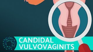 What Is Vaginitis  VULVOVAGINITIS [upl. by Cerf]