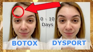 Botox Vs Dysport  Before and After [upl. by Ursal]