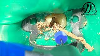 How To Remove GuttaPercha Easily During Root Canal Retreatment Cases  Easy GuttaPercha Removal [upl. by Semele332]