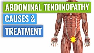 Abdominal Tendinopathy  Causes and Treatment Including Exercises [upl. by Stricklan659]