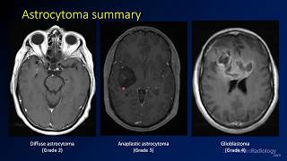 Glioma Brain Tumors Surgical Therapies and Current Genetic Studies [upl. by Aneev]