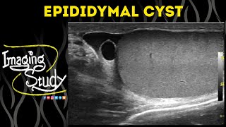 Epididymal Cyst  Ultrasound  Case 51 [upl. by Gerrilee]