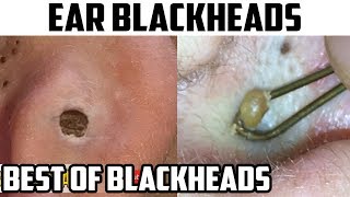 Ear Blackheads  Comedones Comedo Blackhead Removal amp Pimple Excision [upl. by Olumor]