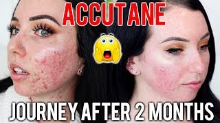 MY ACCUTANE JOURNEY 2 MONTH UPDATE Before amp After Side Effects Skin Care Products Im using [upl. by Giefer544]