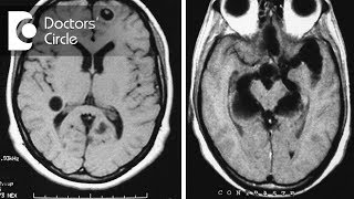 Pulmonary Tuberculosis in Hindi  Stages  Causes  Pathophysiology  Sign amp Symptoms [upl. by Annahsohs]