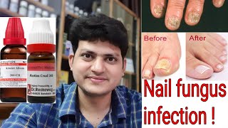 Nail fungus  Homeopathic Medicine for Nail fungus infection  Explain [upl. by Hyman539]