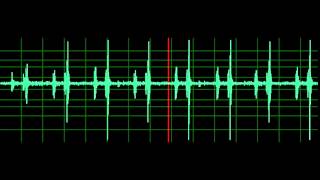 Pulmonary Associated Heart Sounds PAH Split S2 [upl. by Magavern]