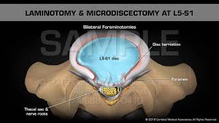 Laminotomy amp Microdiscectomy at L5S1 [upl. by Bill453]