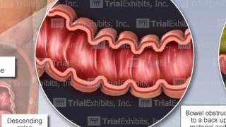 Bowel Perforation [upl. by Sethi388]