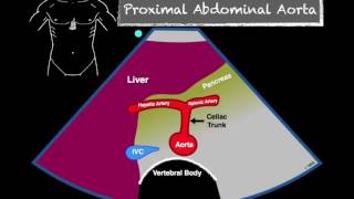 Aneurisma en aorta abdominal [upl. by Ashlee964]