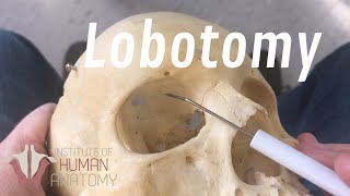 The Anatomy of a Lobotomy [upl. by Johnsson601]