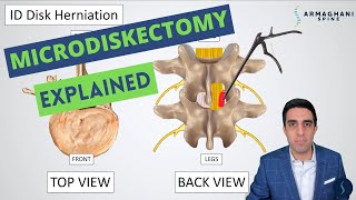 Microdiskectomy Anatomy Step by Step Procedure Risks Recovery and Restrictions [upl. by Leif]