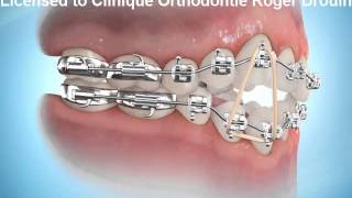 Port délastiques en orthodontie [upl. by Novit]