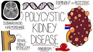 Polycystic Kidney Disease Explained [upl. by Alethea]